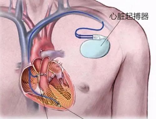 政策解读 | 进口心脏起搏器有哪些监管要求？